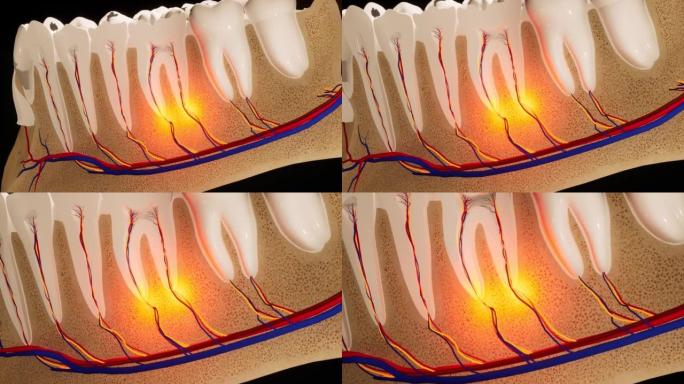 牙痛。牙齿的解剖详细部分。神经发炎。3D动画