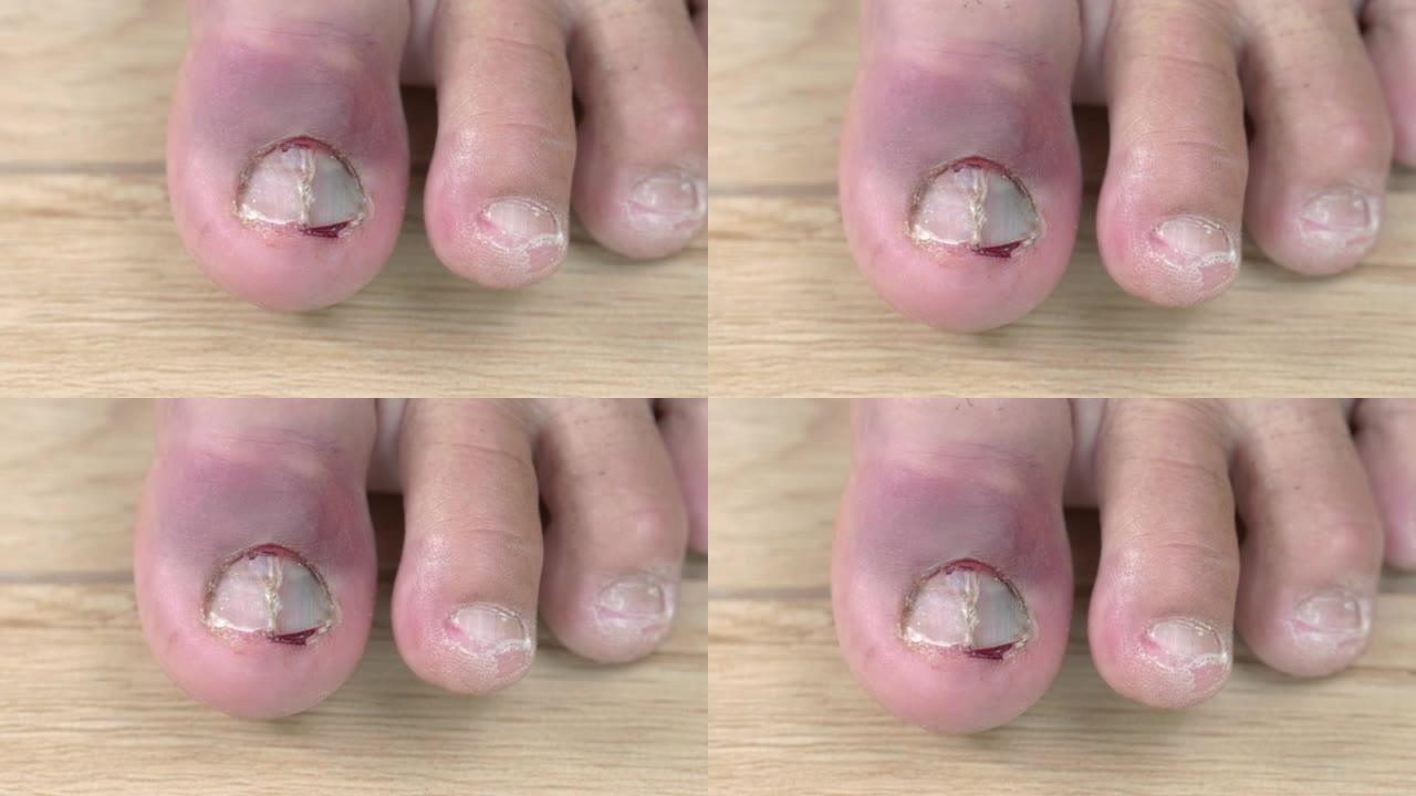 左脚脚趾甲瘀伤甲沟炎指甲流血指甲受伤