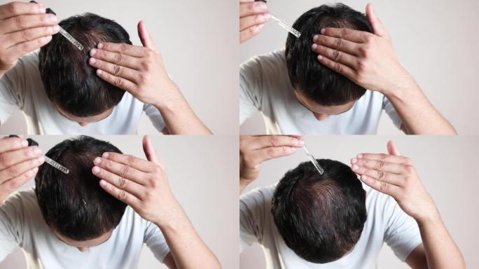 男人在秃头头皮上使用米诺地尔治疗脱发