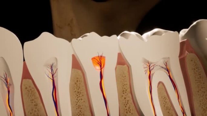 牙痛。牙齿的解剖详细部分。神经发炎。3D动画