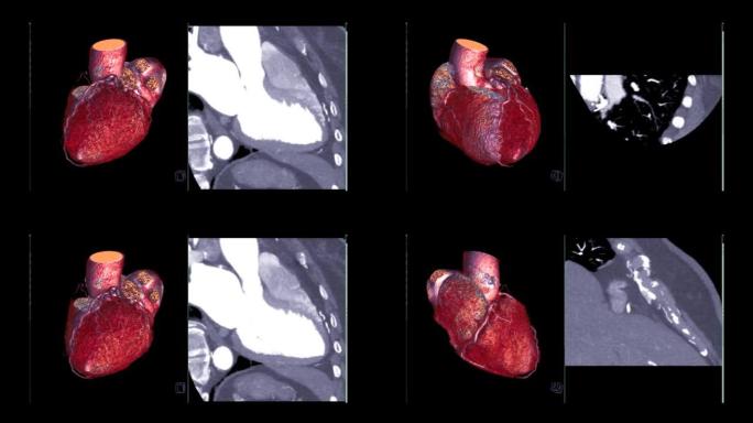 CTA冠状动脉三维渲染。