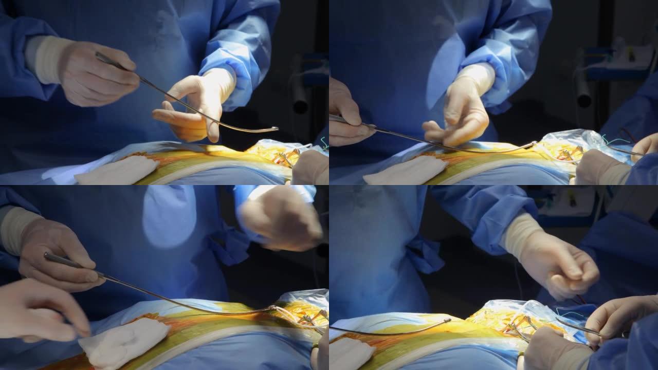 神经外科医生进行脑室-腹膜分流。