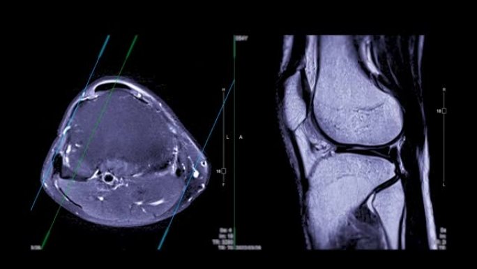 MRI膝关节或膝关节的磁共振成像。