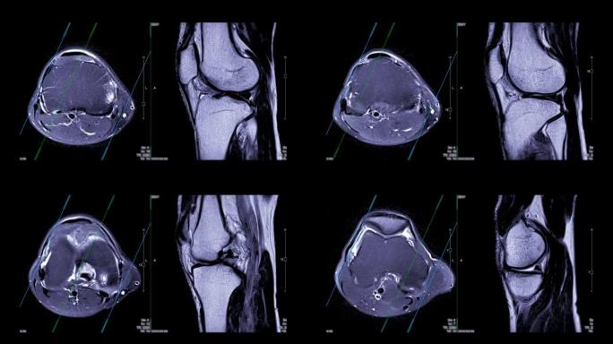 MRI膝关节或膝关节的磁共振成像。