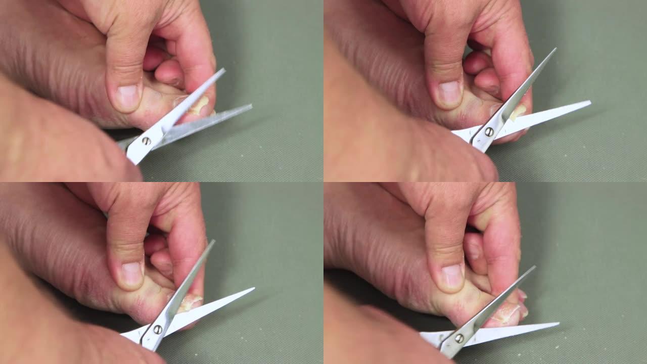 金属剪刀在大脚趾上剪指甲的特写。