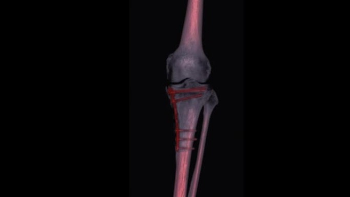 膝关节三维渲染的ct扫描。