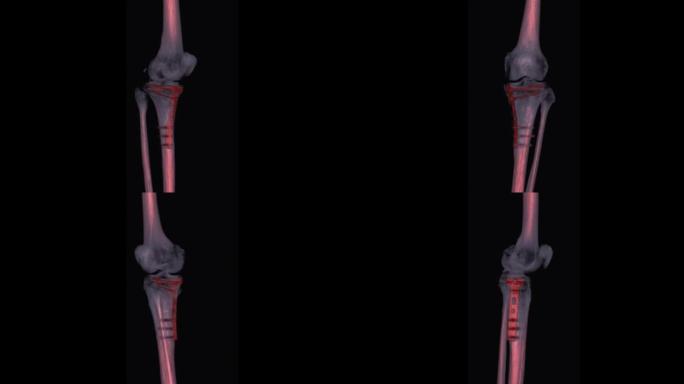 膝关节三维渲染的ct扫描。