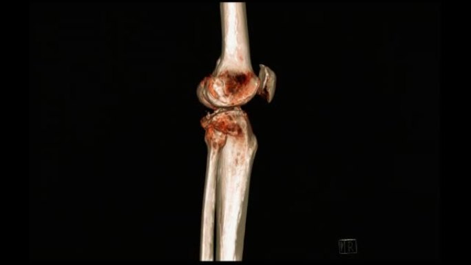 膝关节三维渲染的ct扫描。