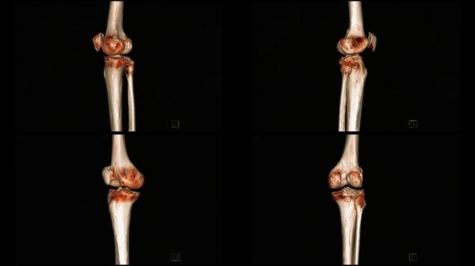膝关节三维渲染的ct扫描。