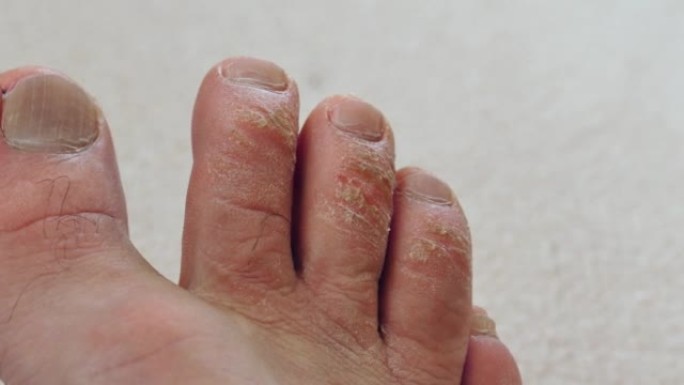 脚趾上的愈伤组织形成，人脚的特写，脚趾上的老茧，