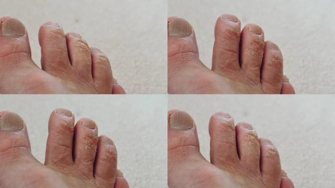 脚趾上的愈伤组织形成，人脚的特写，脚趾上的老茧，