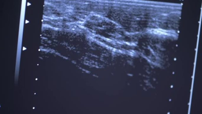 乳房超声检查结果的监视器上的特写图像。