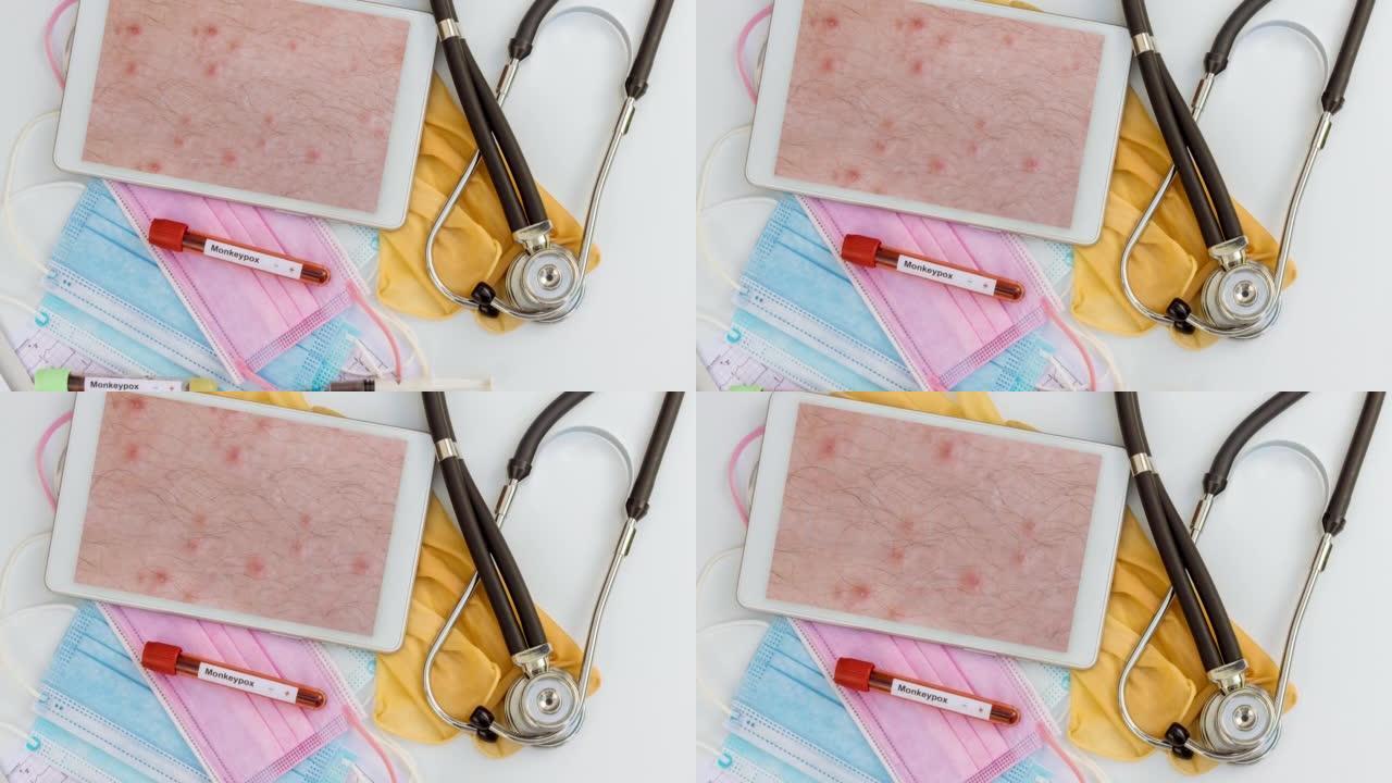医生检查病人在数字平板上看皮疹时对猴痘进行血液检查