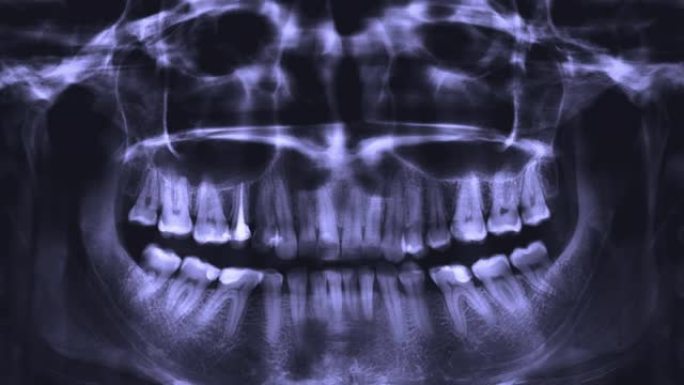 人体牙齿全景x射线图像的停止运动视频。