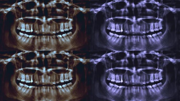 人体牙齿全景x射线图像的停止运动视频。