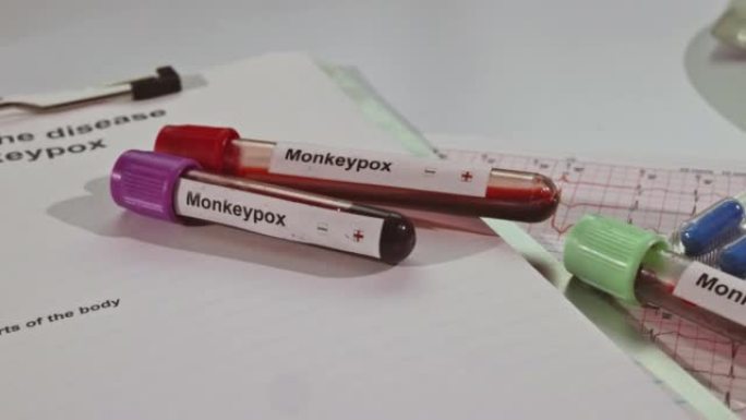 血液样本多其他血液试管检查分析医院阳性猴痘天花