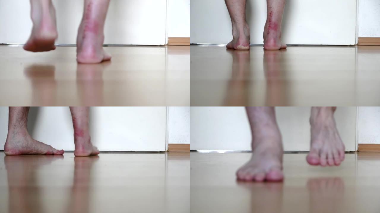 欧洲男子跟腱断裂后的第一步手术显示医院伤口缝合显示缝线和手术横断行走赤脚疼痛和部分负重PWB