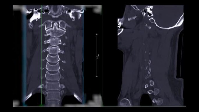 颈椎ct扫描