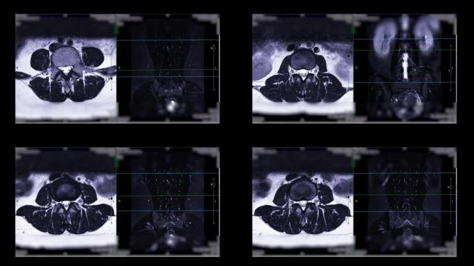 MRI l-s脊柱或腰椎。