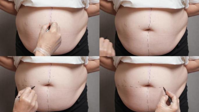外科医生在腹部进行整形手术时会在腹部绘制矫正标记