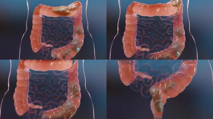 人体消化系统解剖，肠道概念，泻药，便秘治疗，3d渲染
