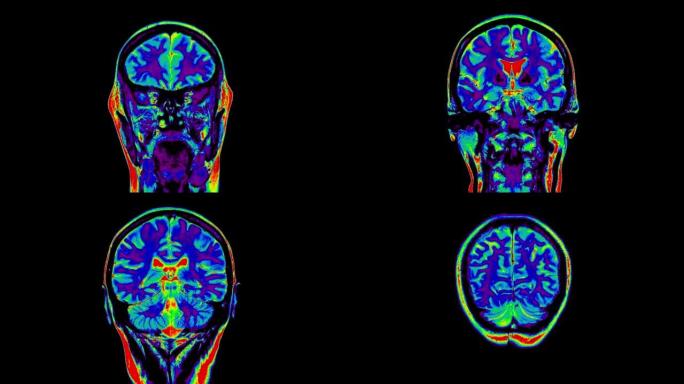 大脑mr扫描颜色。脑磁共振扫描，成像红色和蓝色，前部，角膜视图，蓝色。正常脑部MR扫描，成像。脑部彩