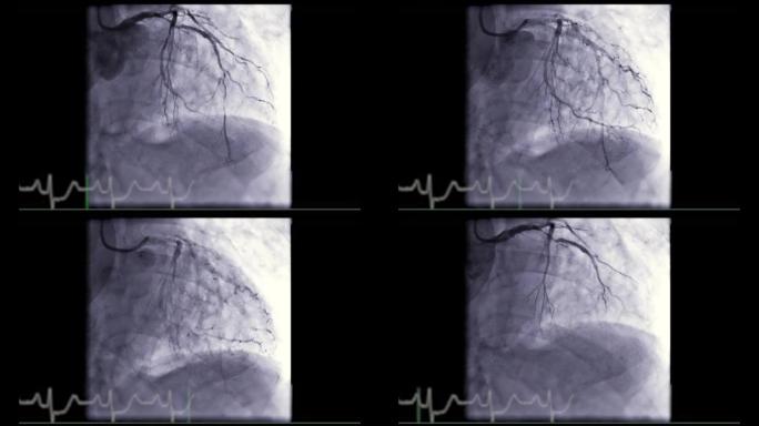 心脏导管插入术是一种用于发现心脏骤停的测试。