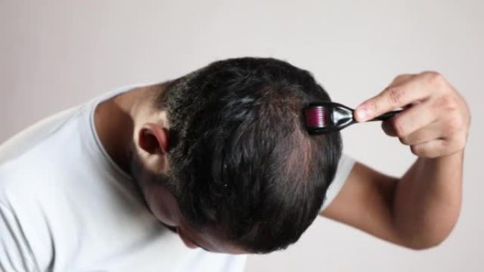 男子应用微针脱发治疗秃头头皮治疗男性型秃发