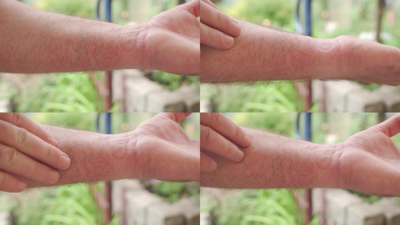 手部皮肤上的刺激和红斑。过敏性皮肤反应，皮疹。特写。