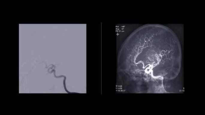 脑血管造影术。
