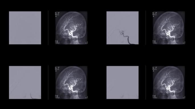 脑血管造影术。