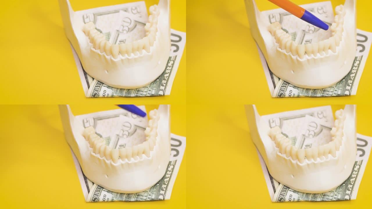 牙齿和钞票的人的下巴，牙科植入价格