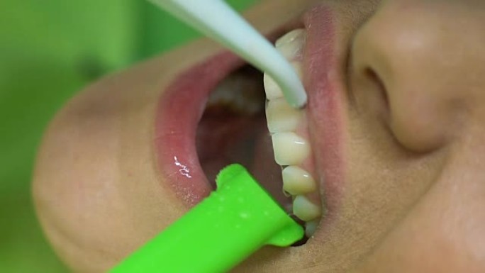 医生用水工具清洗患者牙齿的密封残留物，治疗