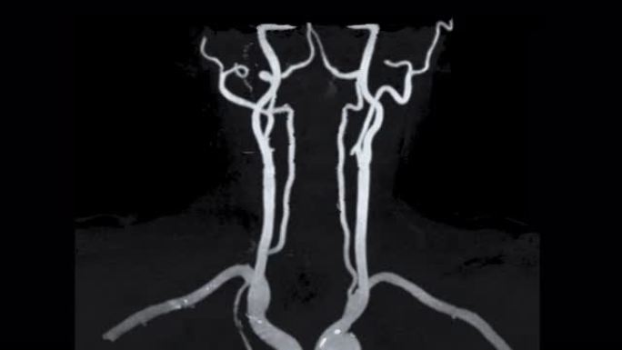 MRA颈动脉冠状MIP视图显示颈总动脉。