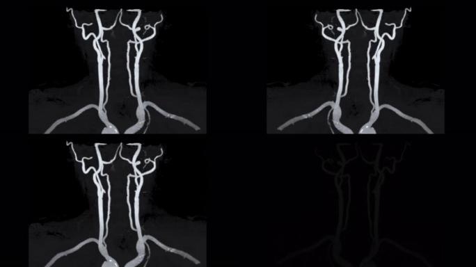 MRA颈动脉冠状MIP视图显示颈总动脉。