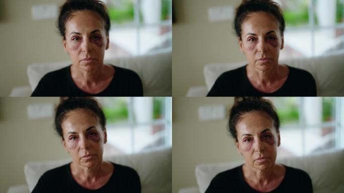 中年西班牙妇女遭受家庭暴力，眼睛瘀伤在家里