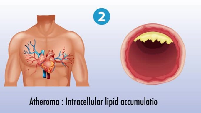 动脉硬化血管疾病 (动脉粥样硬化) 动画