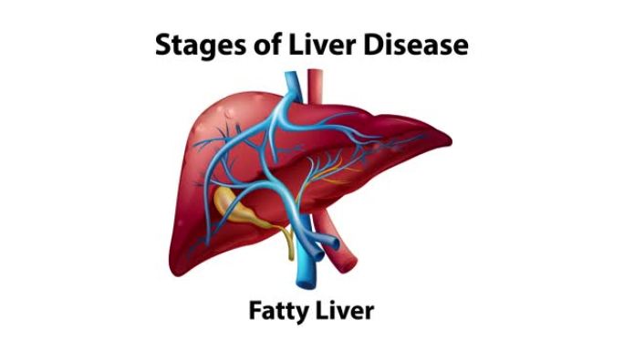 肝脏疾病阶段的2D动画。