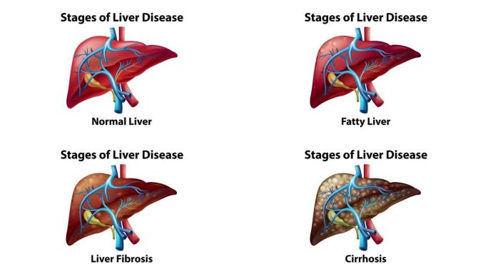 肝脏疾病阶段的2D动画。