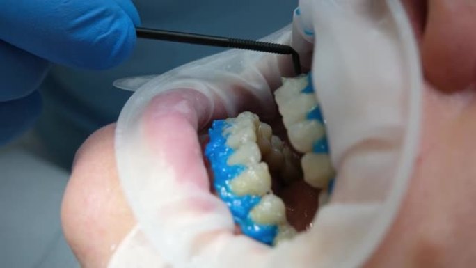 液体围护隔离牙龈从漂白剂的作用，optragat旋转播布特写病人的牙齿在美白过程中在牙科诊所蓝色手套