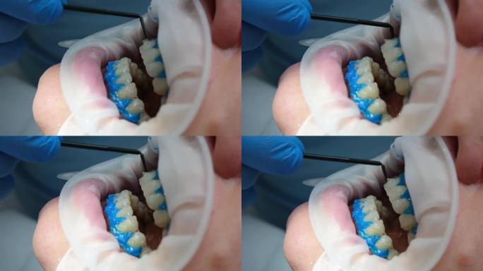 液体围护隔离牙龈从漂白剂的作用，optragat旋转播布特写病人的牙齿在美白过程中在牙科诊所蓝色手套