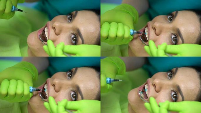 牙医在牙齿上使用蓝色凝胶，造型膏，美容牙科，特写