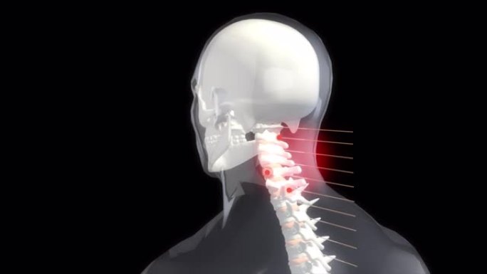 一个疼痛的脖子的3d渲染动画。一名颈部剧痛的男子紧紧抓着自己的脖子。医学概念3d动画。