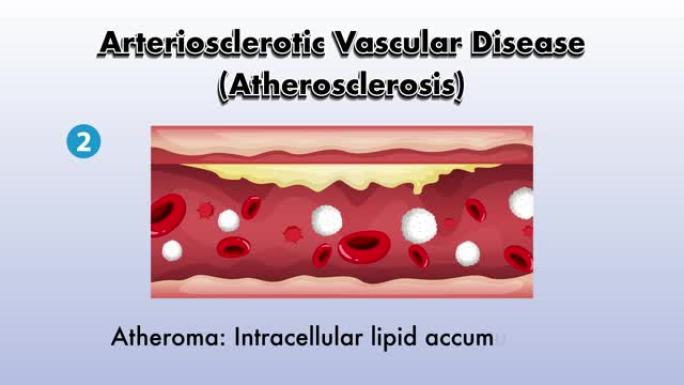 动脉硬化血管疾病 (动脉粥样硬化) 动画