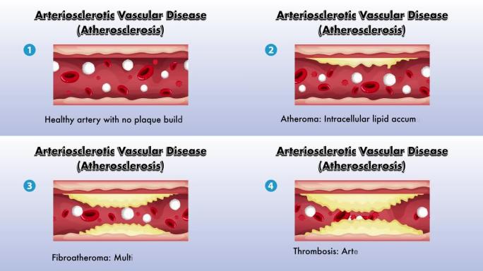 动脉硬化血管疾病 (动脉粥样硬化) 动画