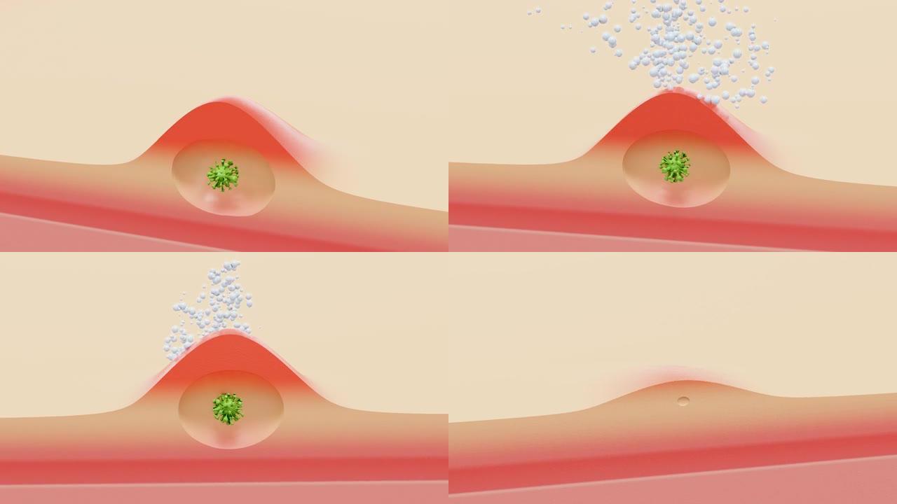 病毒皮下炎症，疱疹-3d动画显示病毒象征性皮炎，并用乳膏治疗。