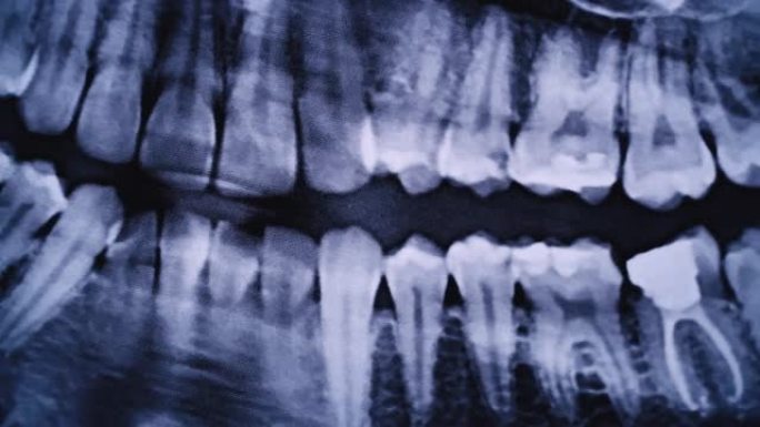 所有人类牙齿的颌骨的x射线图像特写