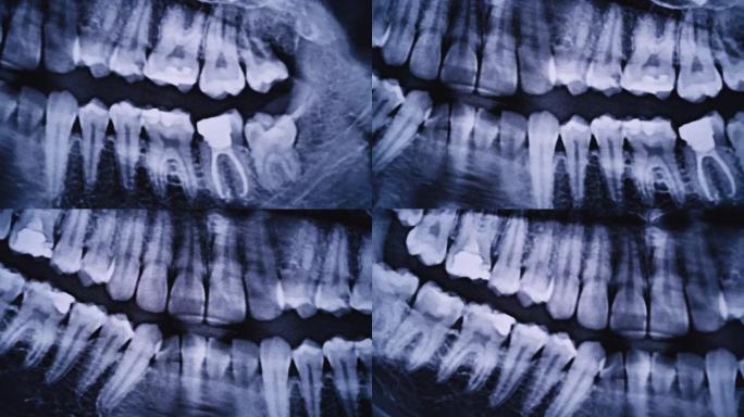 所有人类牙齿的颌骨的x射线图像特写