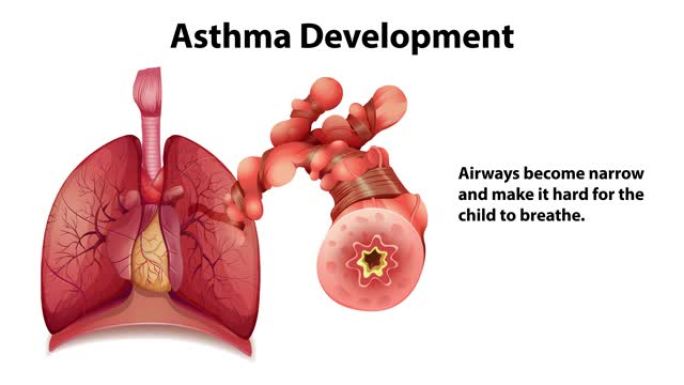 哮喘发展动画与解释