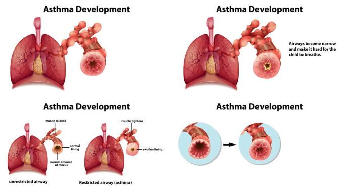 哮喘发展动画与解释